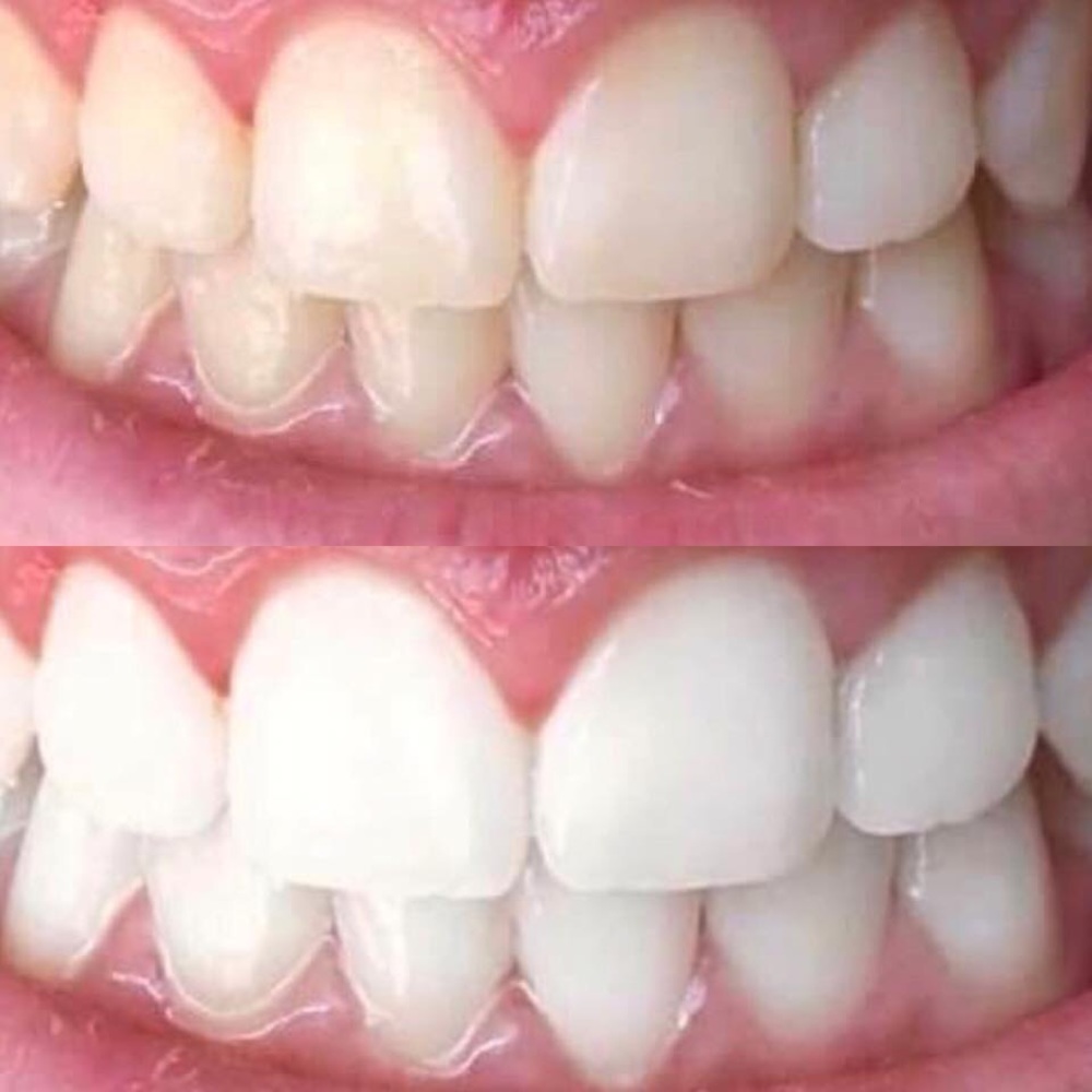 The BEST whitening toothpaste on the market !!